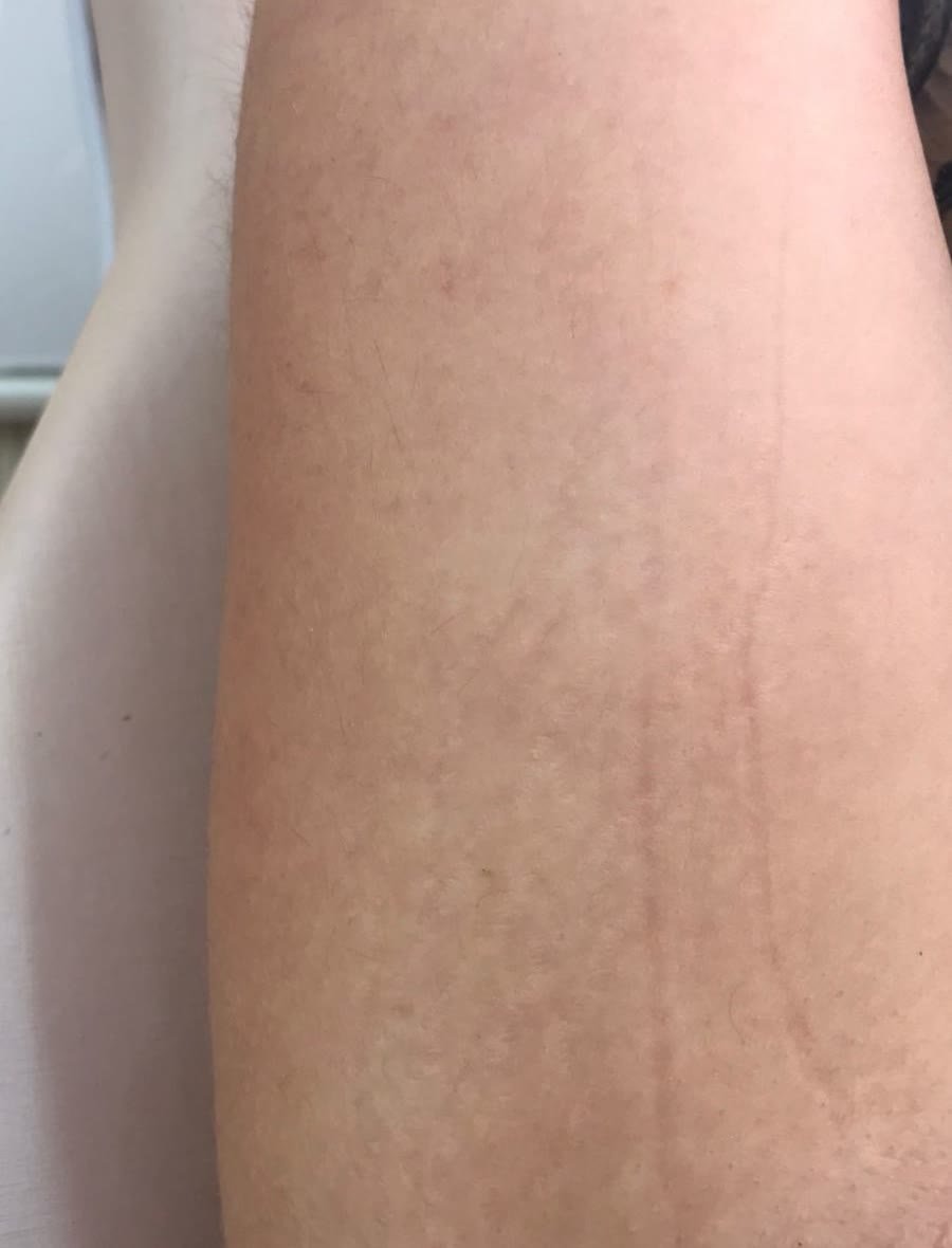 Cicatrizado 40 dias após uma única sessão de tratamento de estrias