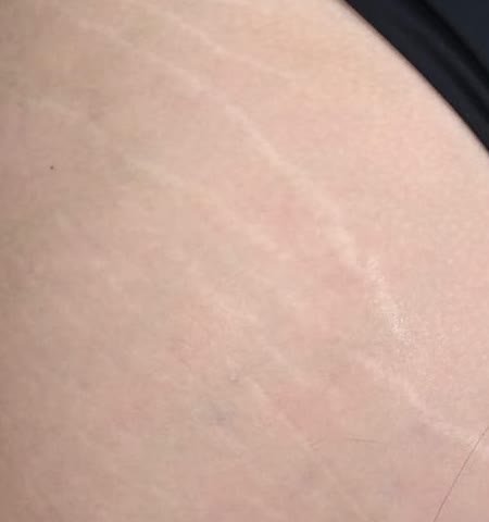 Antes do tratamento de estrias — glúteo