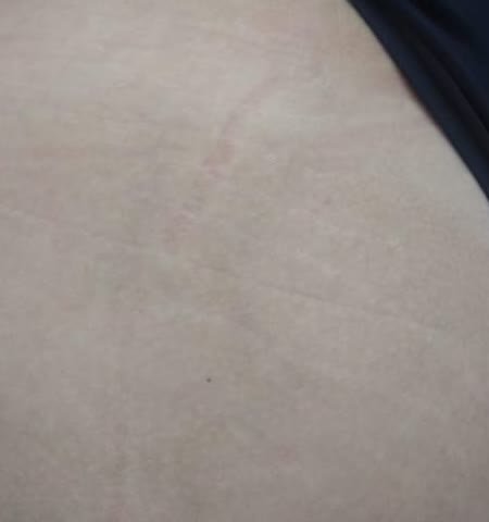 Depois do tratamento de estrias — glúteo